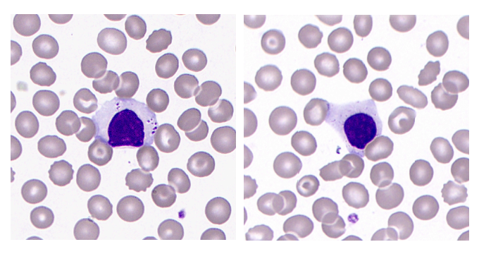 RBC inclusions unveiled: Why peripheral smear still matters? | by ...