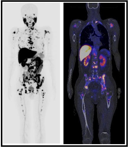 Case Study: 76 years male with Urothelial Carcinoma. | by Dr. Muayad ...