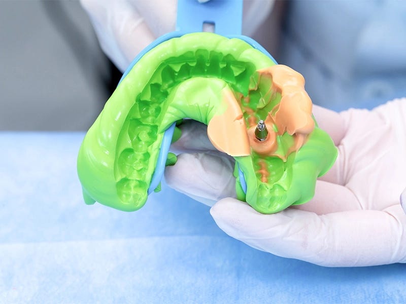 ULTRACORE CORE BUILDUP SOLUTION VINCISMILE Medium