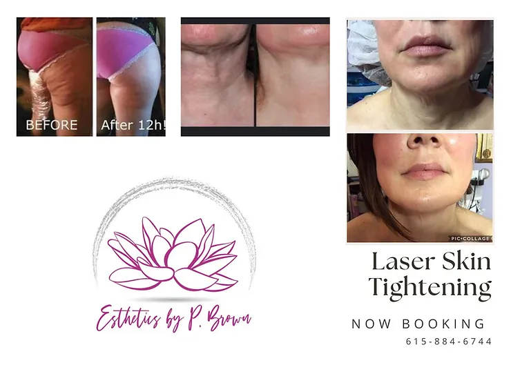 We’re Now Offering Laser Skin Tightening