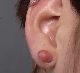 keloid on ear where ear piercing was