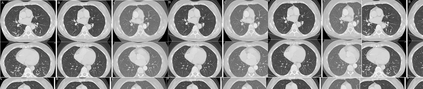 “MLOps for Chest CT Scan Image Classification: A Step-by-Step Guide”