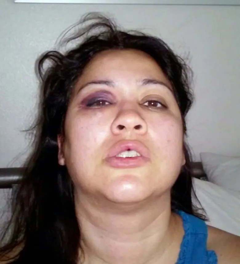 The image shows Lyvette Crespo, who admitted to shooting and killing her husband and Bell Gardens Mayor Daniel Crespo with injuries to her face consistent with domestic abuse.