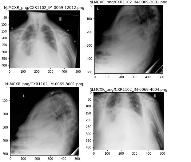 Indiana University — Chest X-Rays Automated Report Generation