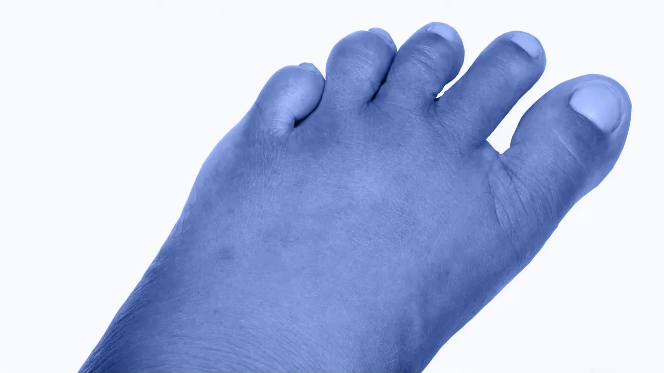 An image of swelling of the foot from a centipede bite