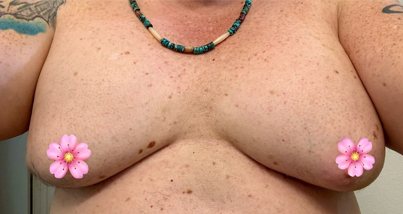 As an Older Trans Woman, I Just Got Big Boobs & They Hurt Like Hell