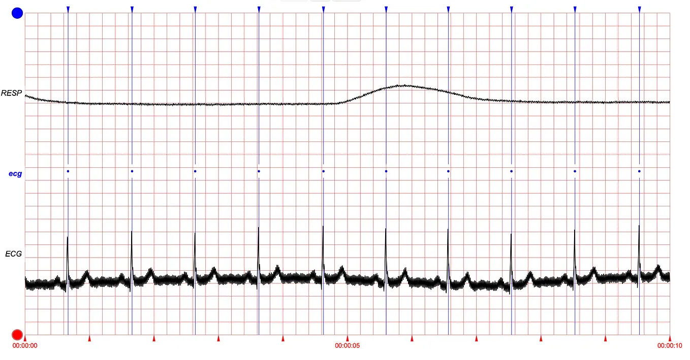 Processing of Fantasia database with Python. Extracting ECG and respiratory rate.