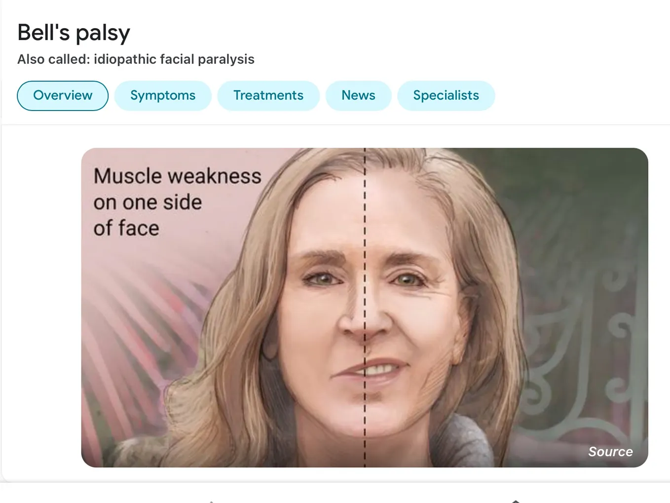 BELLS PALSY OR BALLS PALSY