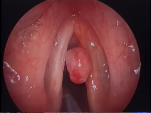 Common Vocal Health Issues (Vocal Polyps)