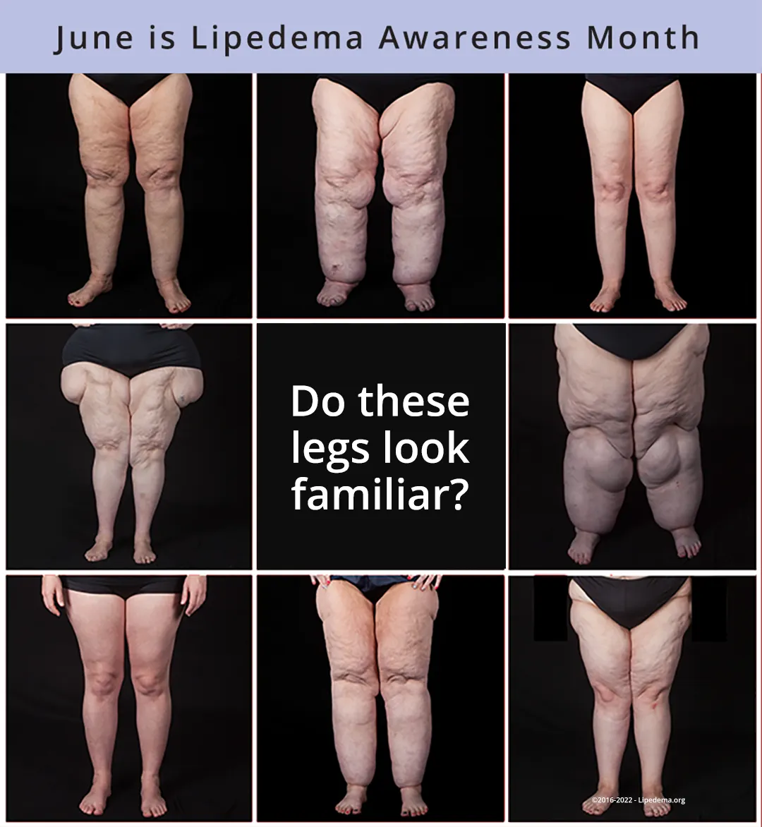 Living with Lipedema