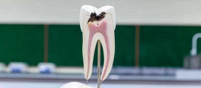 root canal treatment in noida