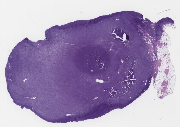 Follicular Lymphoma with Signet Ring Cell Morphology | by Siba El Hussein,  MD | Medium