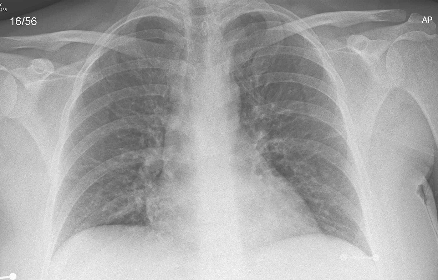 Normal Chest X Ray