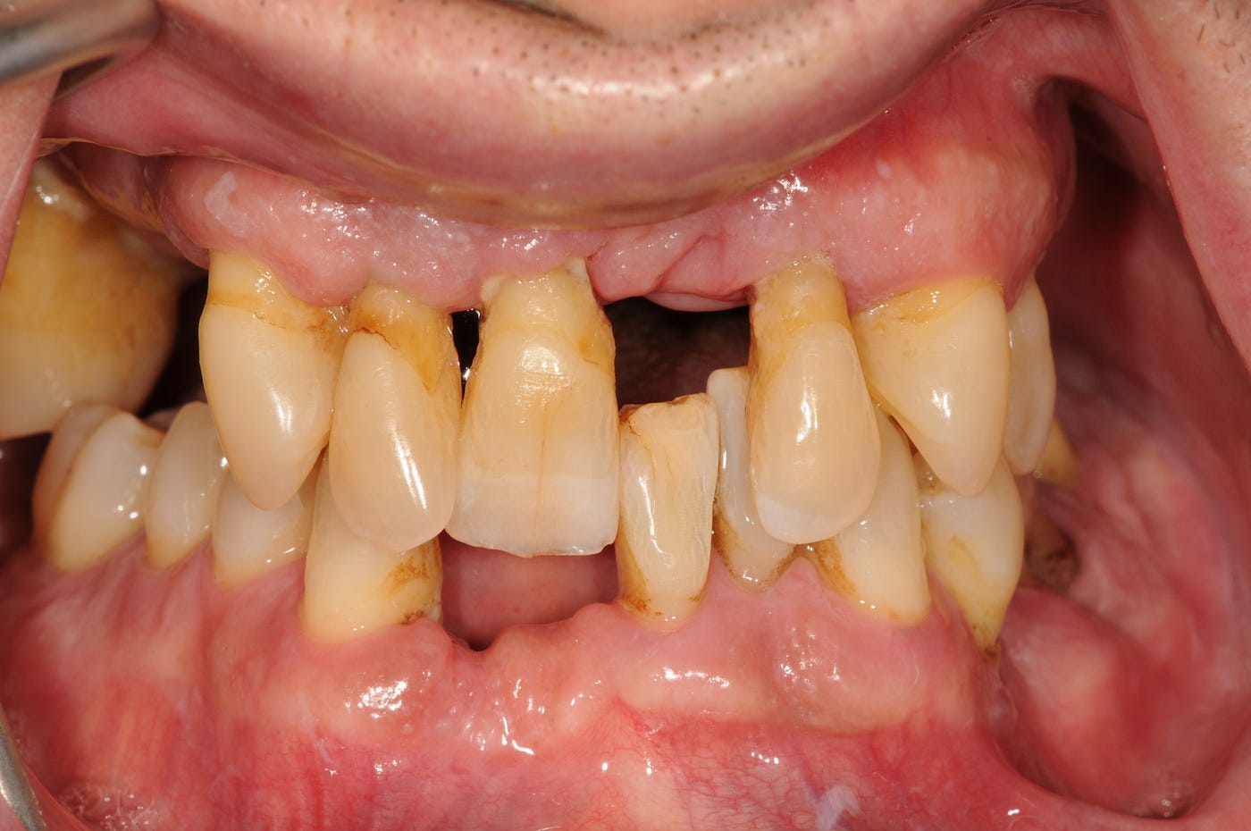 extreme makeover before and after teeth