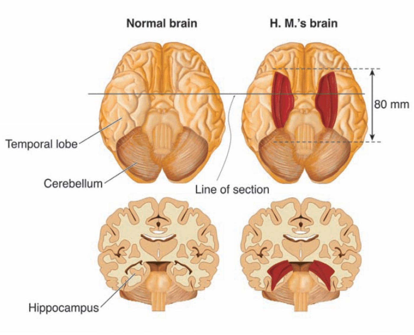 A comparison between a normal brain and Patient H.M.’s brain following the lobectomy. | Source: https://www.researchgate.net/publication/278643309_Morphometry_of_the_human_hippocampus_from_MRI_and_conventional_MRI_high_field