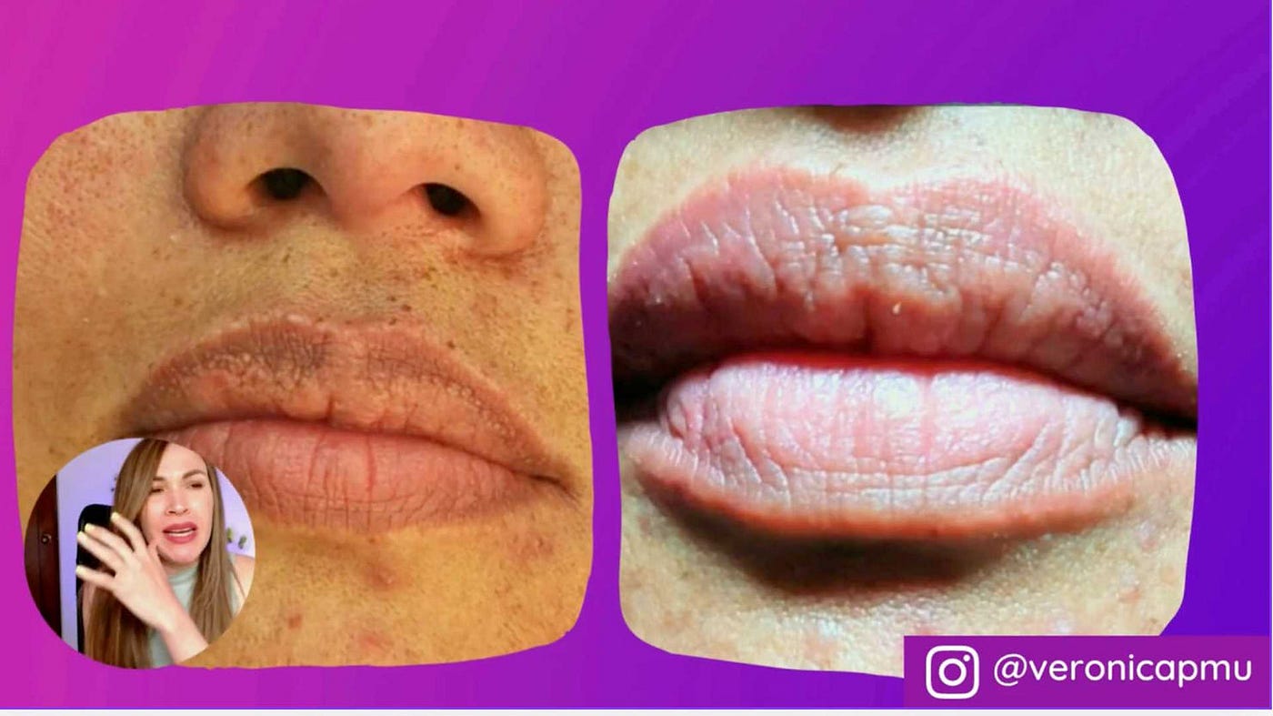 Micropigmentación para Corregir Gránulos de Fordyce en los Labios + VIDEO