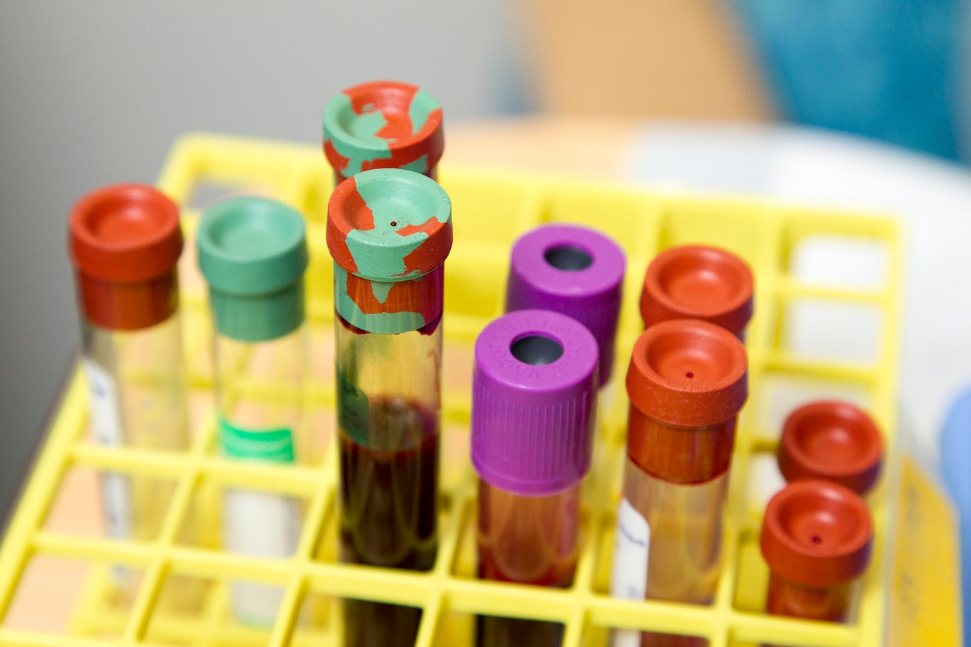 A tray of blood collection tubes with various colored tops. The recent FDA approval for an investigational device study of the Galleri test heralds a new era in cancer screening. The potential of this blood test to detect multiple types of cancer at an early stage could reshape the landscape of cancer diagnosis and treatment.