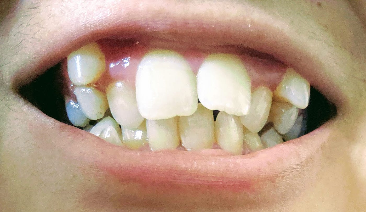 Humans With Shark Teeth