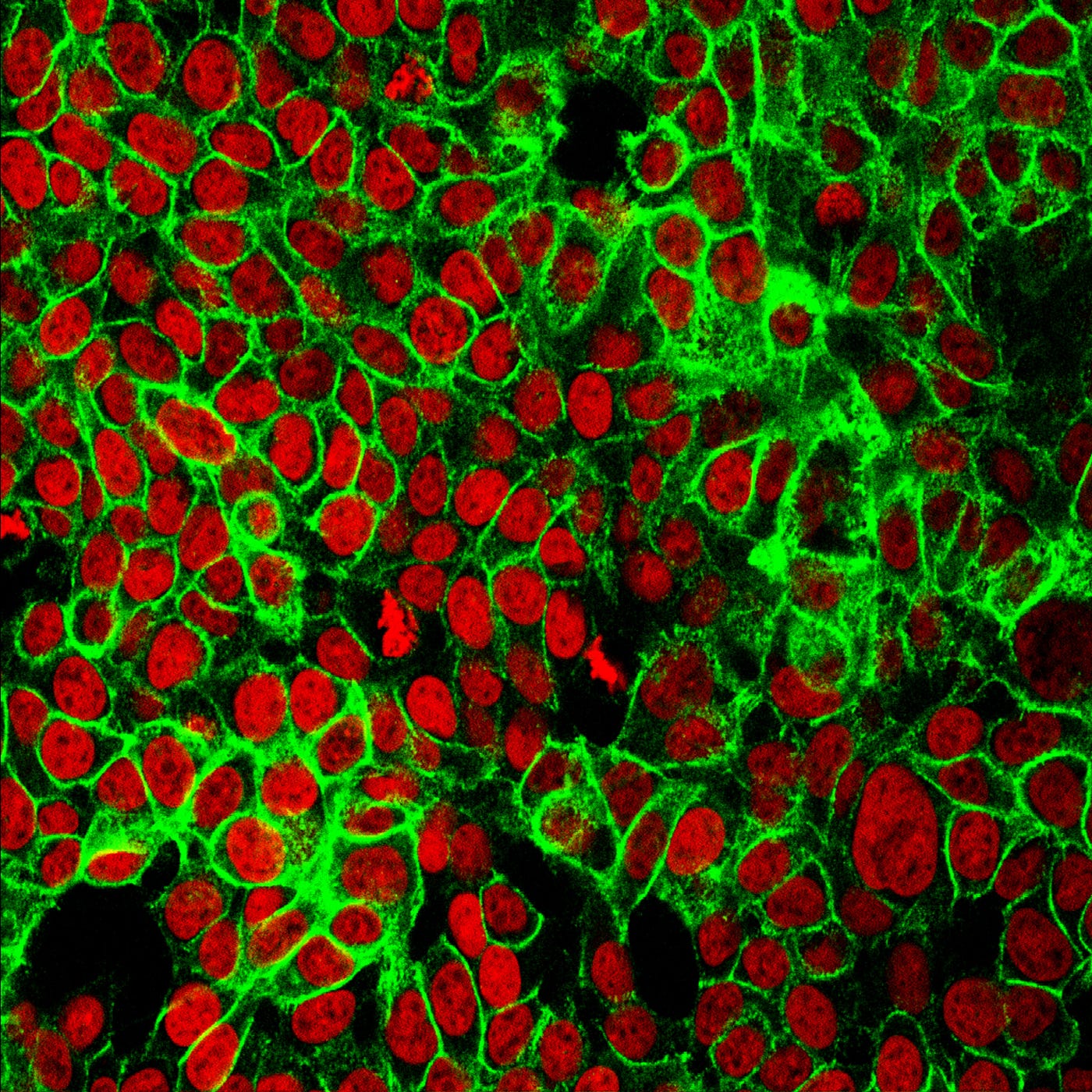 Image of red and green colored cancer cells. There are four cancers for which we have screening: Breast, cervix, colorectal, and lung.
