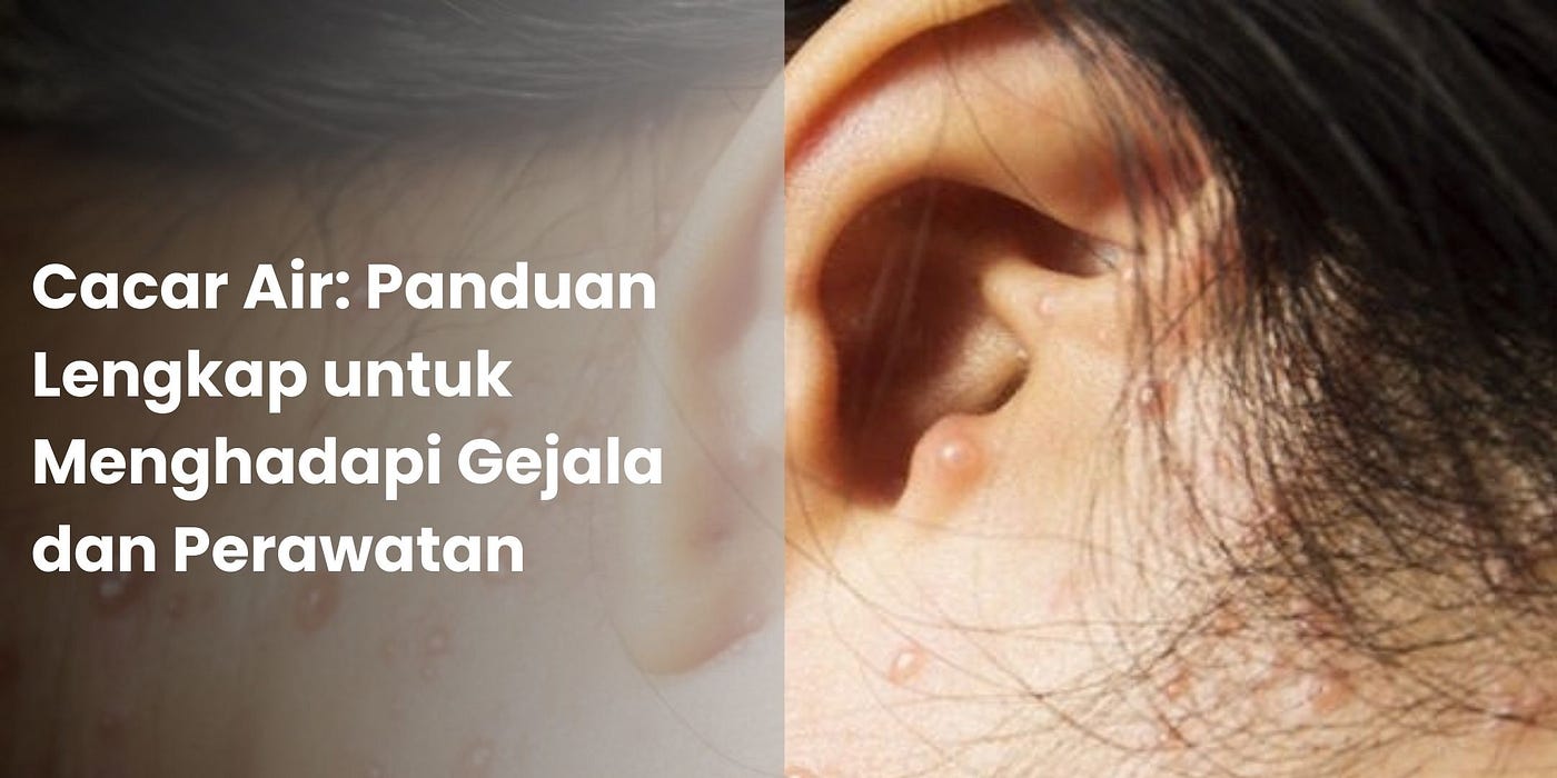 Cacar Air: Panduan Lengkap untuk Menghadapi Gejala dan Perawatan