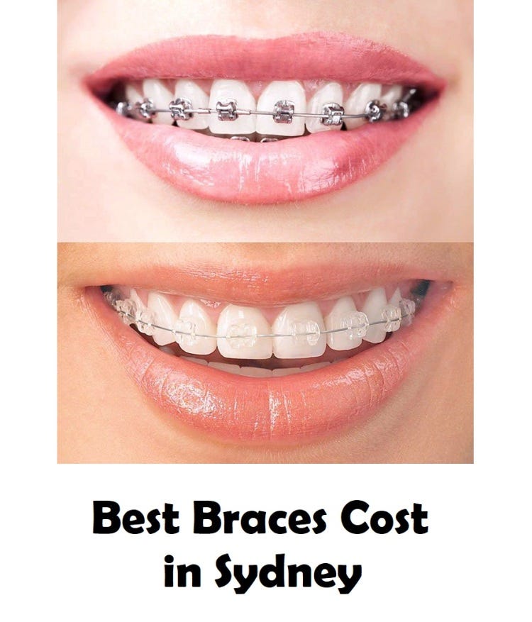 Best Braces Cost in Sydney. How Much Do Braces cost?, by Smilesconcepts