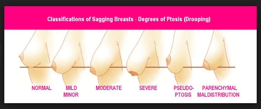 Breast Sagging — Things that every women must know, by Avantika Joshi, Maccablo