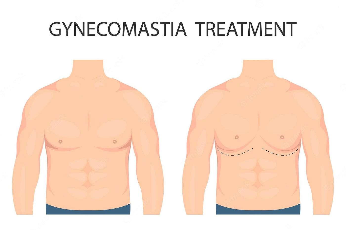 Gynecomastia – Symptoms, Causes, Complications and Prevention
