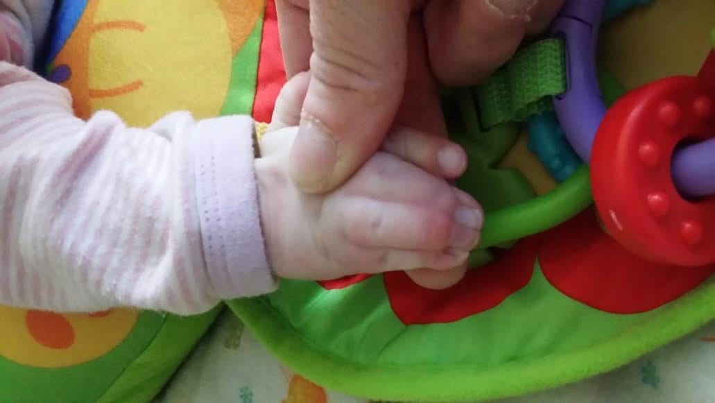 수술 전 테오도라의 벙어리장갑. 합지증을 다시 칠하려면 1년 반 동안 총 네 번의 수술이 필요할 것입니다.<BR> 긴 QT 때문에 마취로 인한 심장마비 위험이 있습니다.<BR> 또한 티모시 증후군 아이들은 면역 체계가 약하기 때문에 생명을 위협하는 감염 위험도 있습니다.<BR> (사진: 저자 제공)