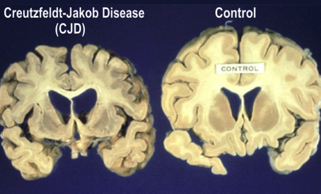 Creutzfeldt Jakob Disease (CJD). What is Creutzfeldt Jakob Disease? | by  Aditya Bagwe | Medium