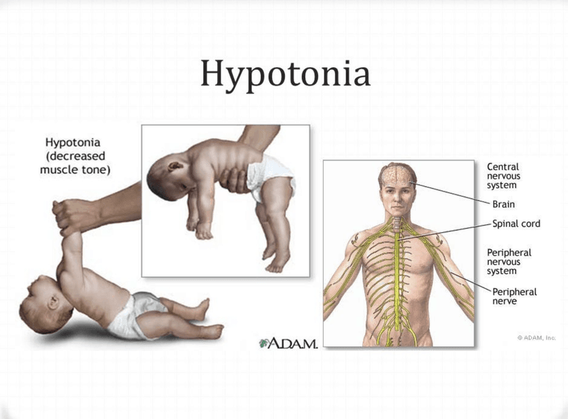 poor-muscle-tone