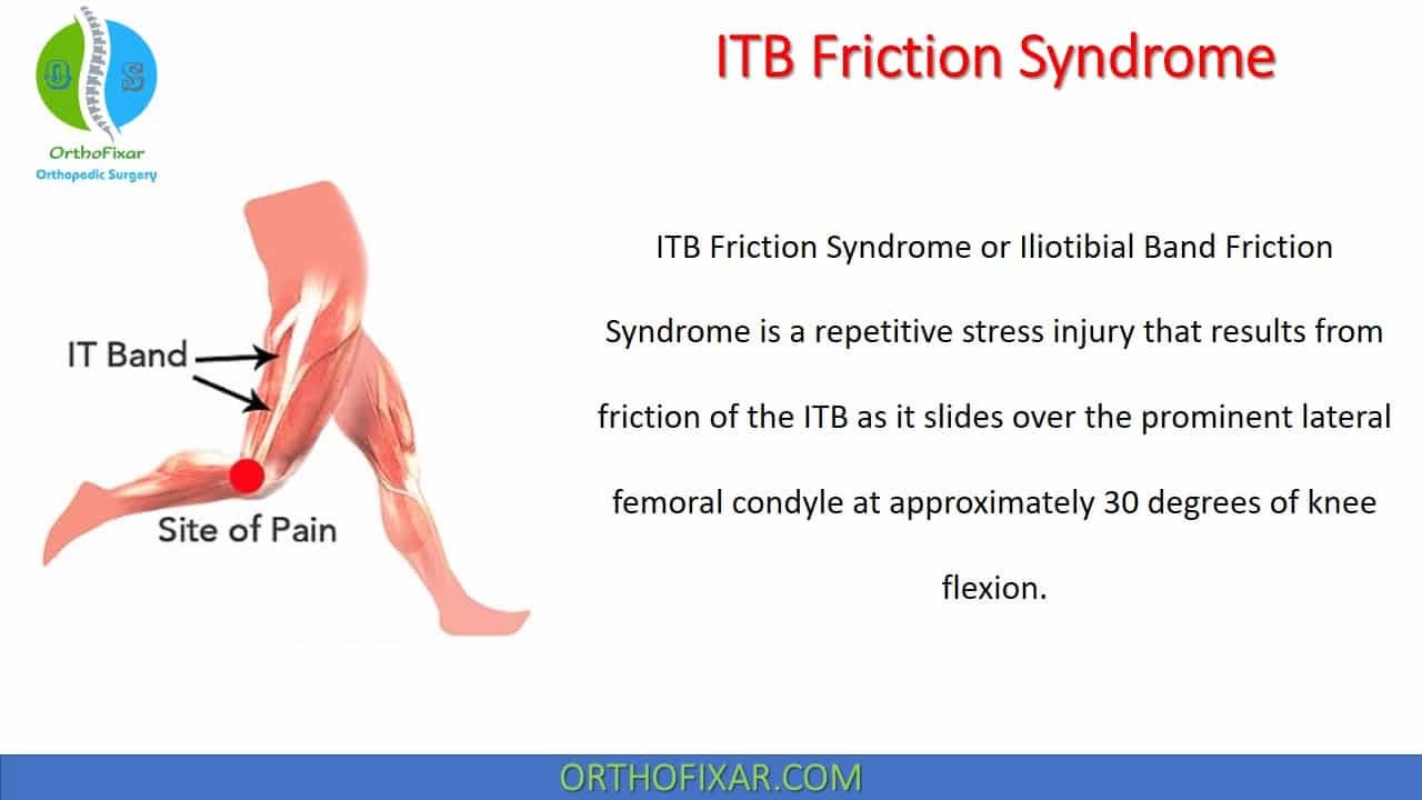 ITB Friction Syndrome, by Orthofixar Orthopedic