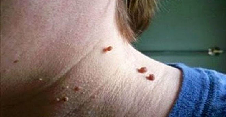 Effective ways to Get rid of Warts Naturally