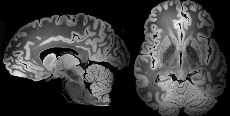 MRI Analysis