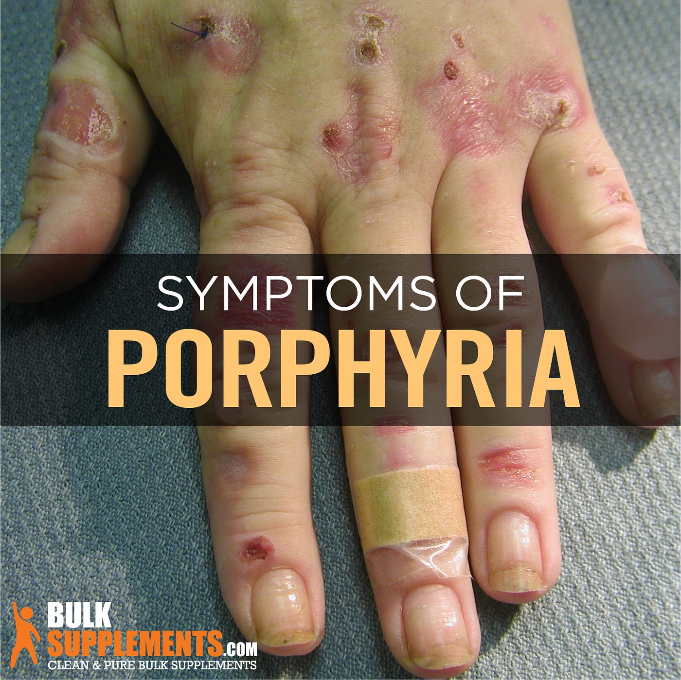 Porphyria: Symptoms, Causes & Treatments | by Oscar Jones | Medium