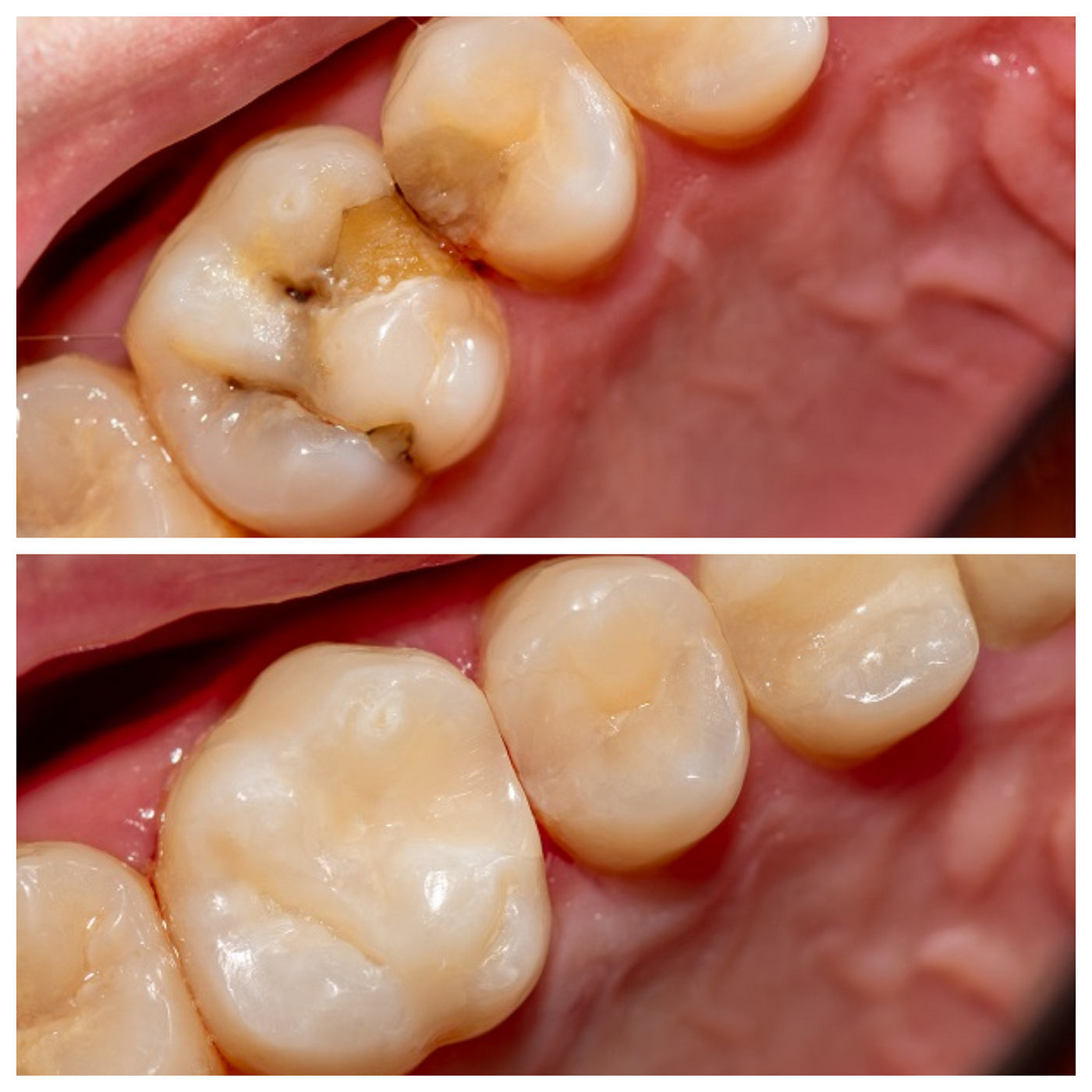 What you should know about Composite Fillings