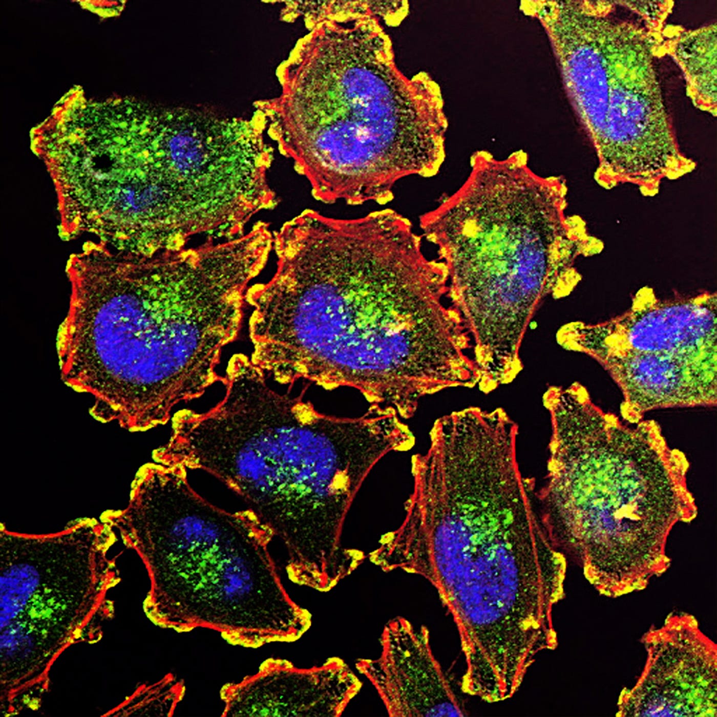 Cancer cells under a microscope. The cells are depicted in vibrant green purple, and red (with a black background). Increased consumption of minimally processed and fresh foods appeared to be associated with reduced overall risk for cancer and risk for specific cancers.