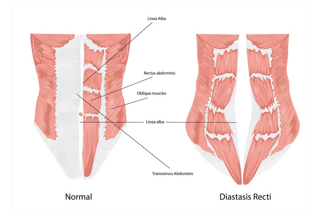 Diastasis Recti And The Pressure To Love A Broken Body | by Michele Merritt  | Medium