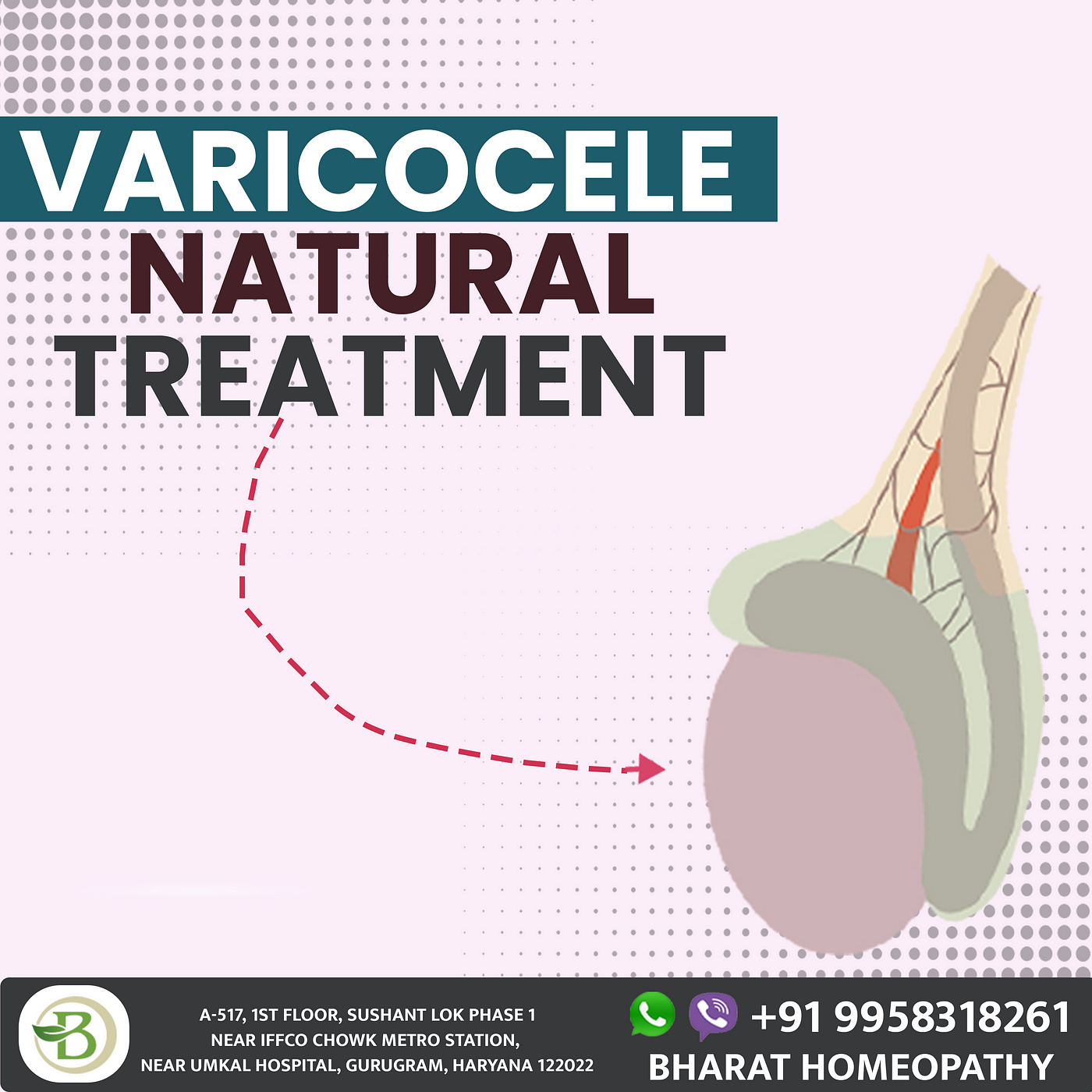 Homeopathic Treatment for Varicocele: An Effective Solution for