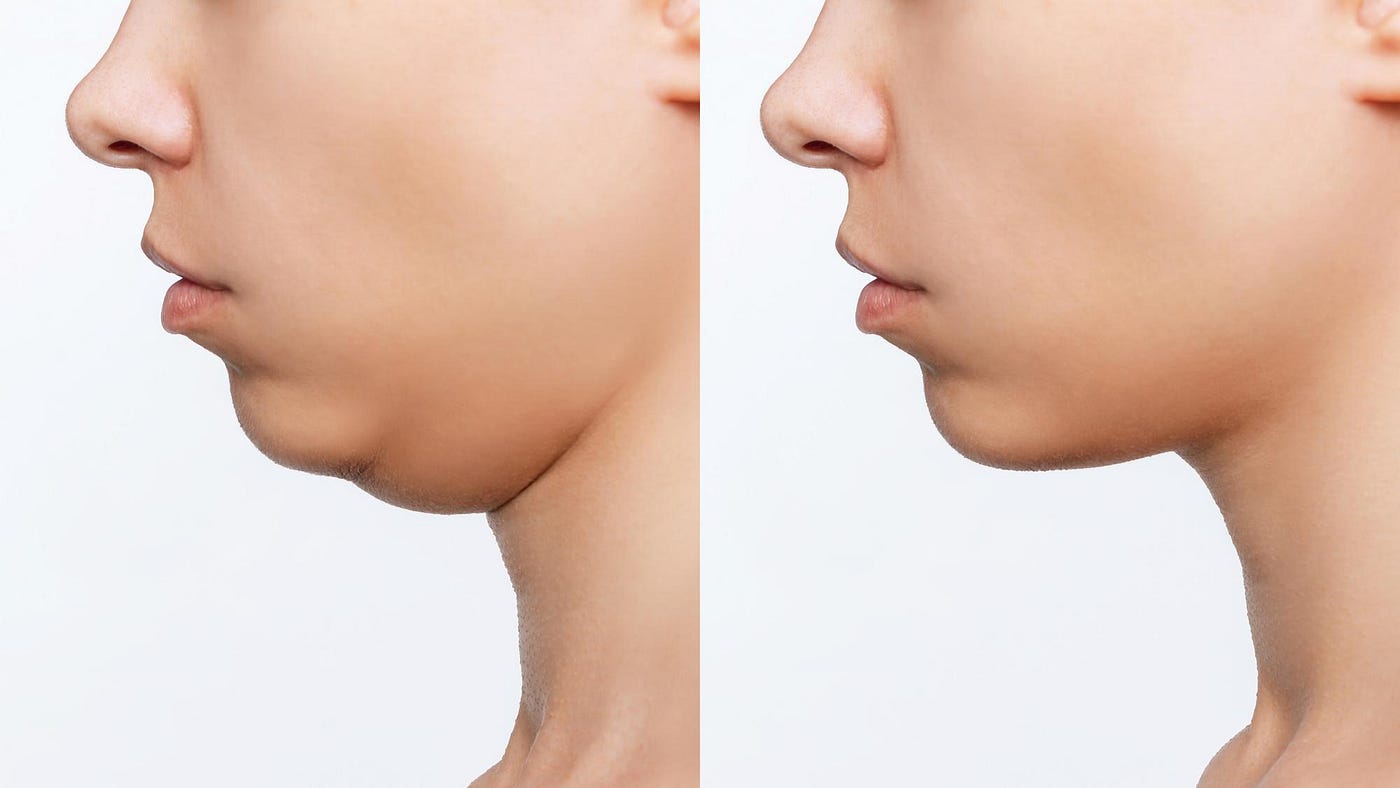 Redefine Your Profile: How Neck Liposuction Can Transform Your Look