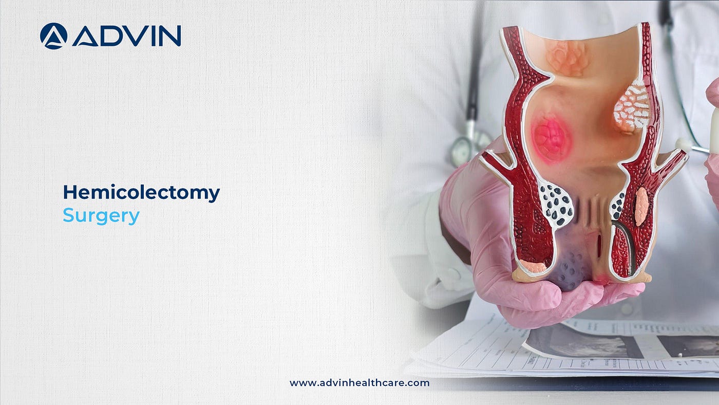 Hemicolectomy Surgery: A Colon Resection Approach
