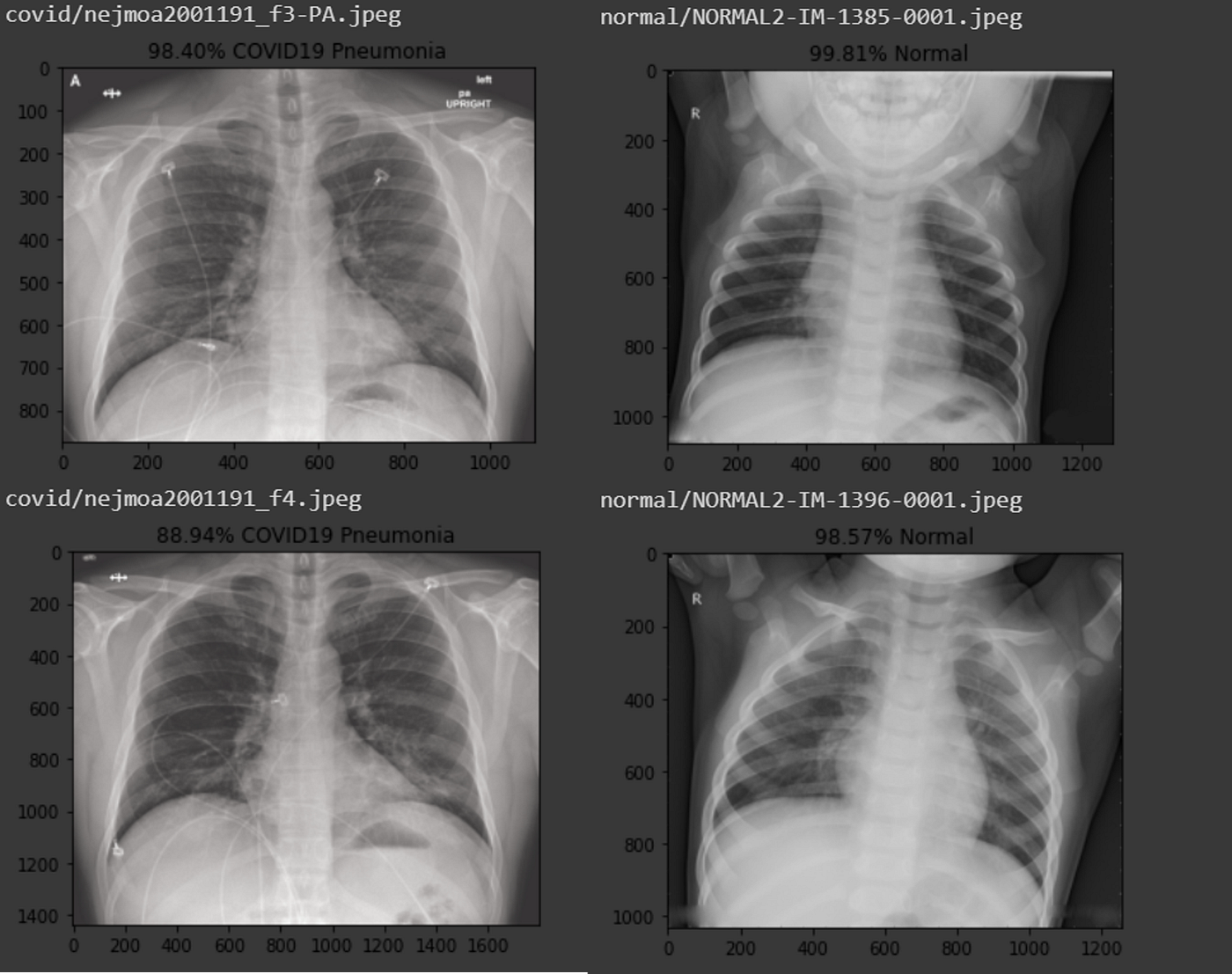 Pneumonia Chest X Ray Compared To Normal