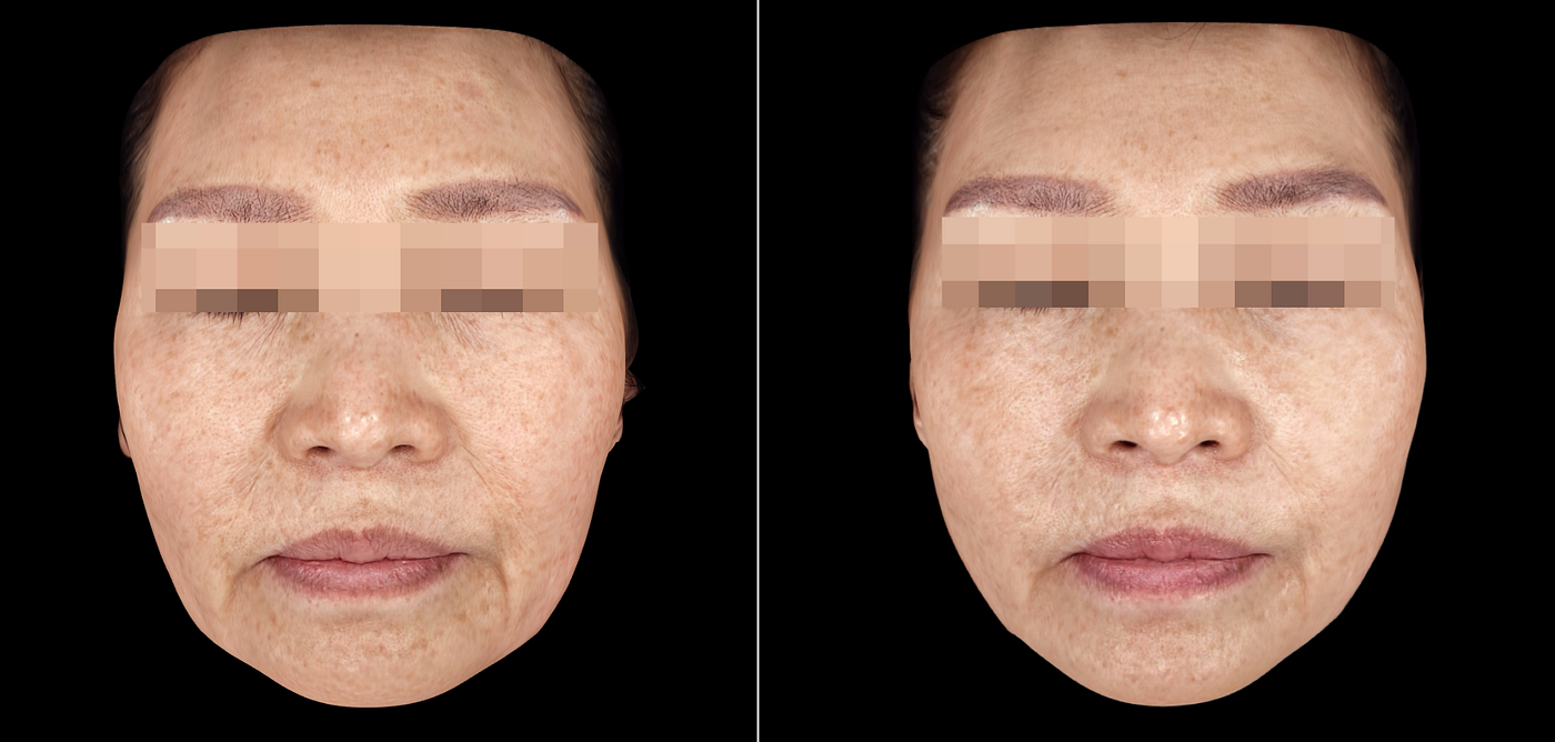Ultherapy for women in their 60s: Before & After