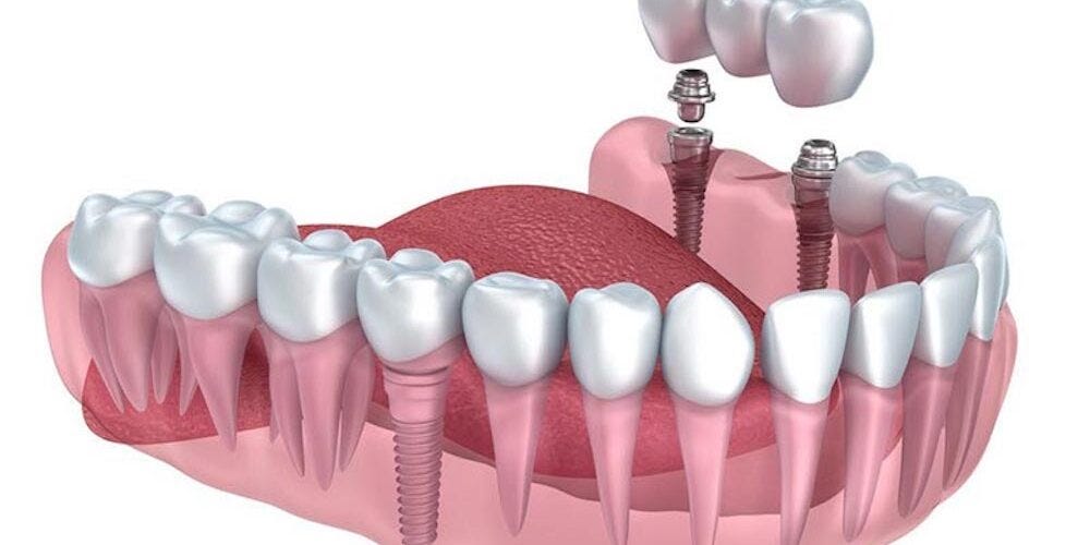 dental implants in noida