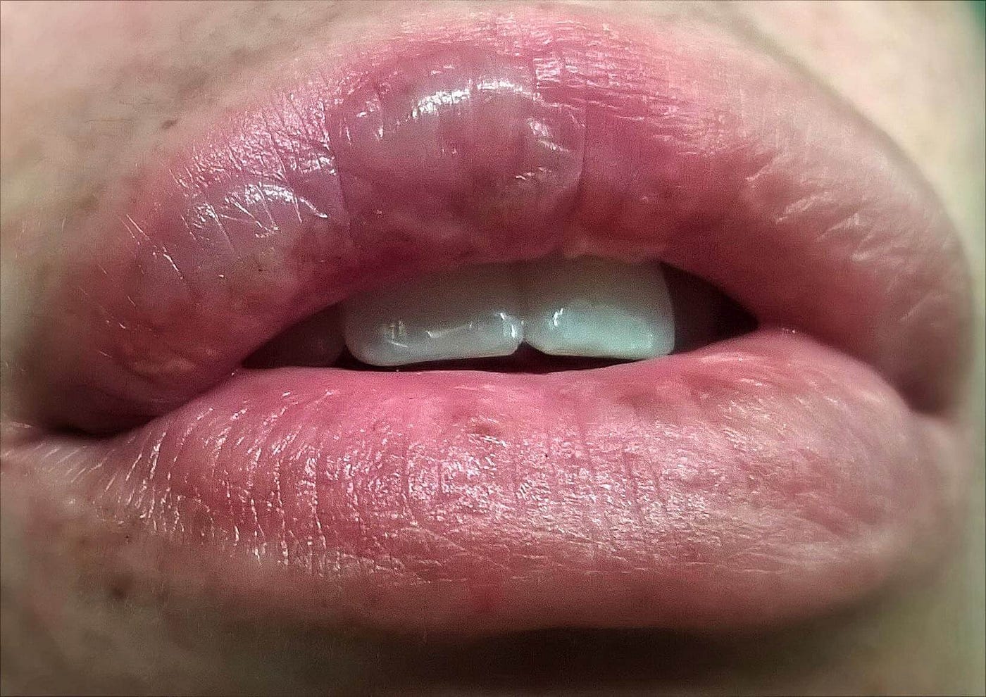 Lip Burning, its Causes, and Consequences | Medium