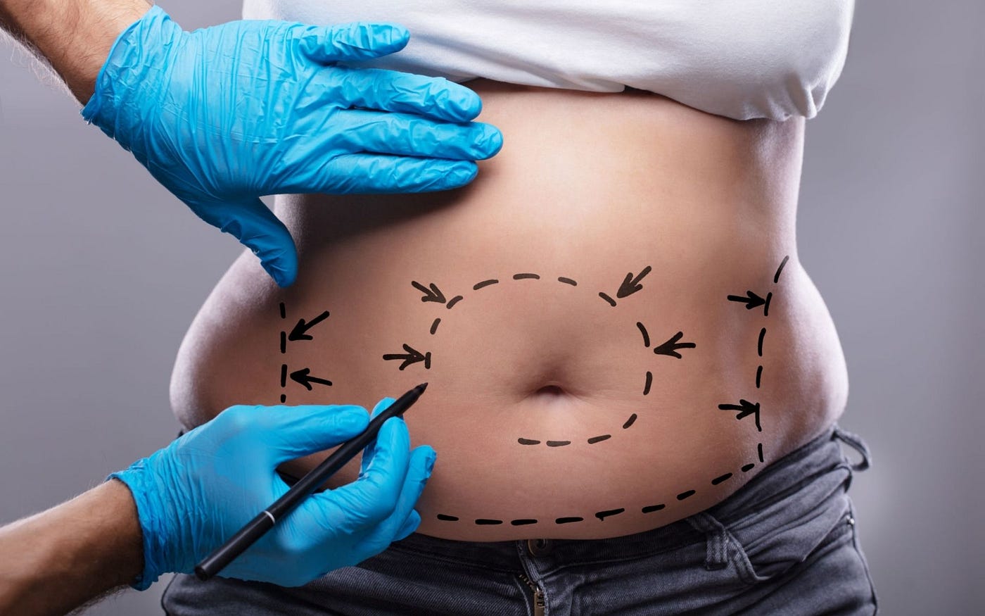 How Tummy Tuck Surgery Removes Excess Skin and Tightens Abdominal Muscles