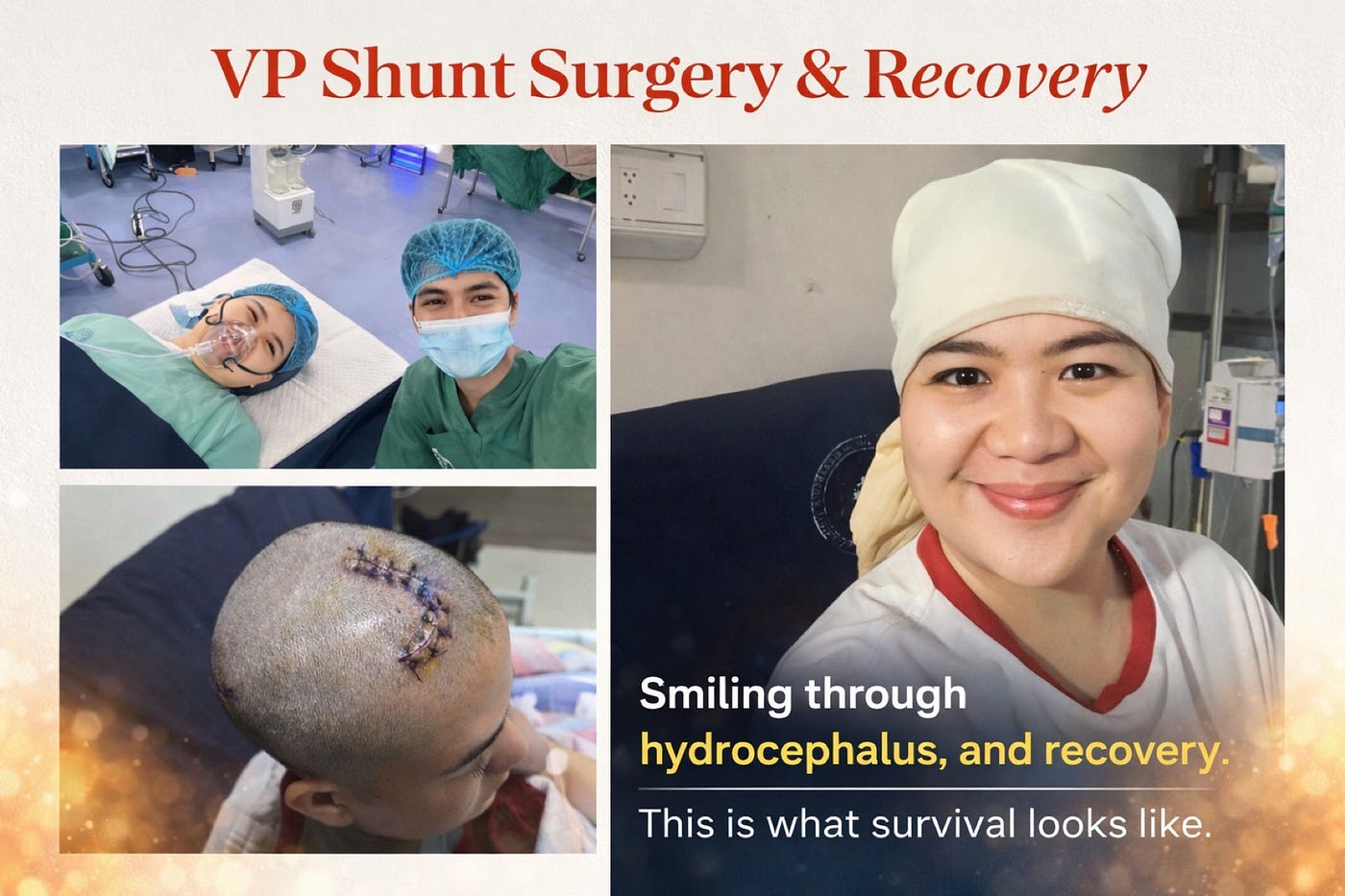 VP Shunt — My Lifeline, My Leap of Faith
