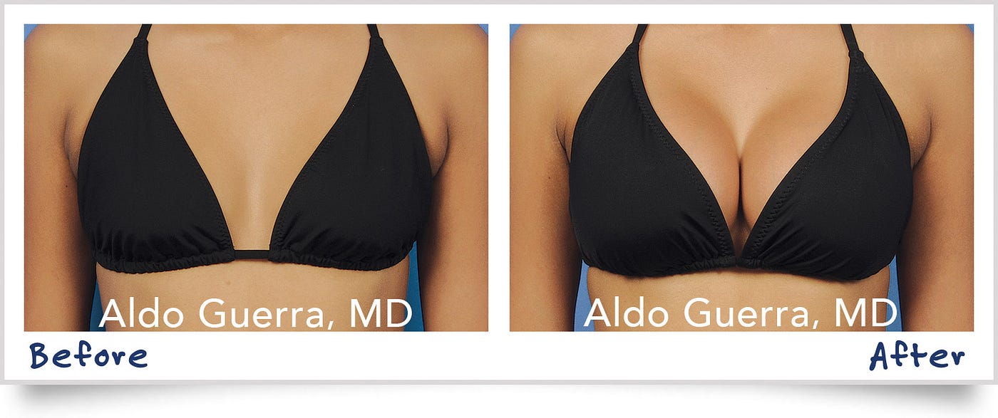 7 Breast Sagging Habits to Break Before It's Too Late, by Guerra Plastic  Surgery Center