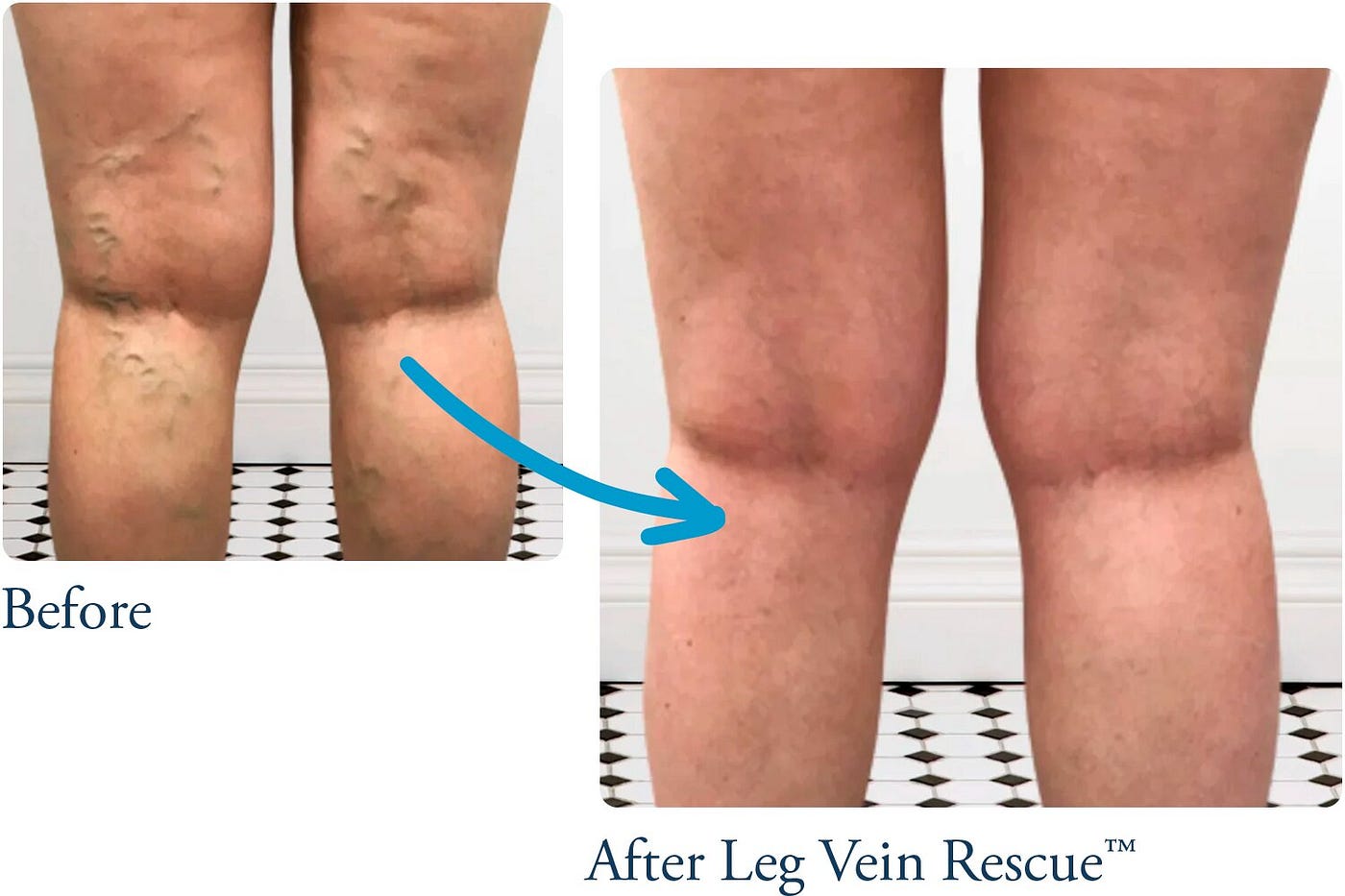 LVR Revolutionizing Leg Vein Health with Innovative Supplements