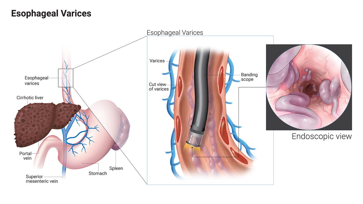 Esophageal Varices Treatment: Managing and Preventing Complications | by  Gayatri Aher | Medium