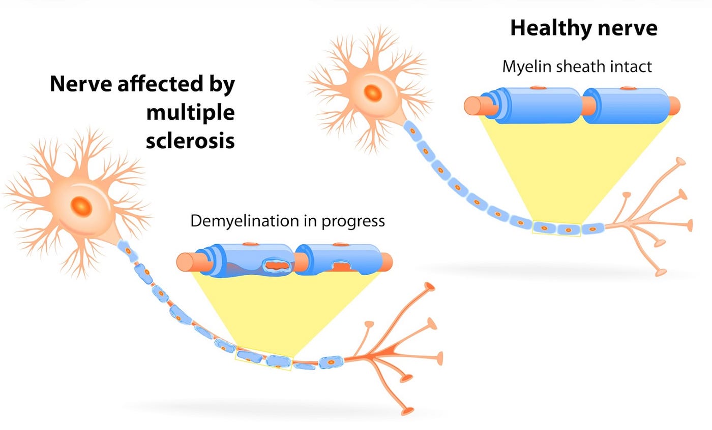 Broken Connections: Understanding Multiple Sclerosis